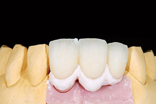 歯肉色陶材・角化歯肉部の調整（Tissue 1＋Silky 1）の写真