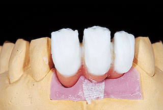 歯冠部陶材最終築盛1の写真