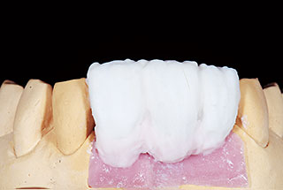 歯肉色陶材（Tissue3）の築盛写真