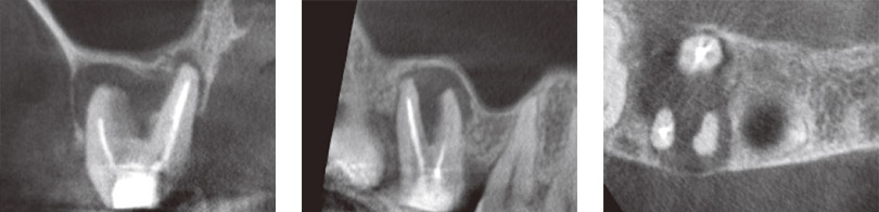 デンタルレントゲン写真（近心頰側根）