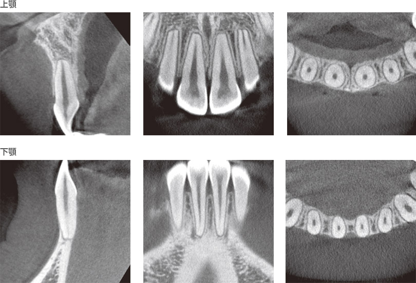 矯正治療後の18歳男子の前歯部のレントゲン写真