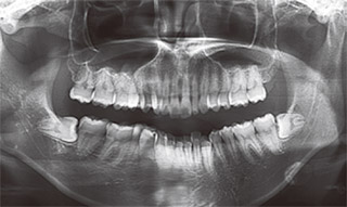 埋伏智歯抜歯の写真