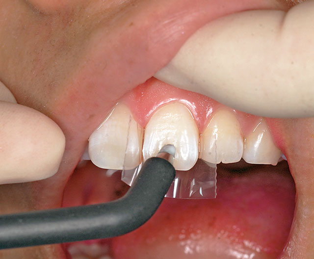 図3 被検歯は歯面を乾燥させ、隣在歯への漏電を防ぐためにプラスティックストリップスで隔離する。電極糊は歯磨剤で代用。