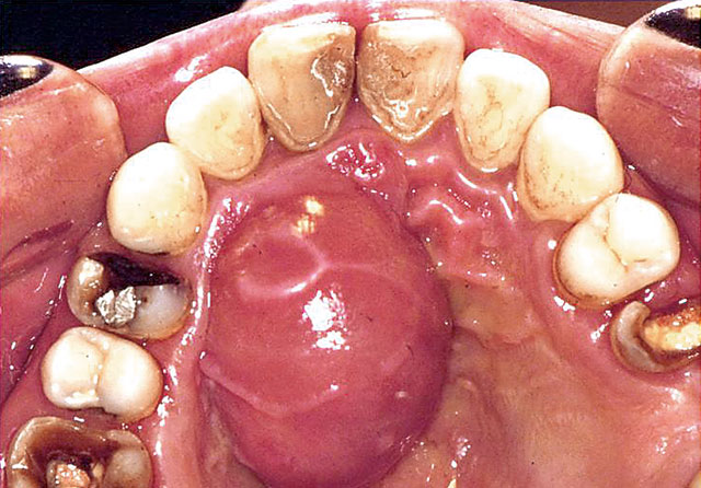 図6 急性歯槽膿瘍（口蓋膿瘍）の口腔内写真