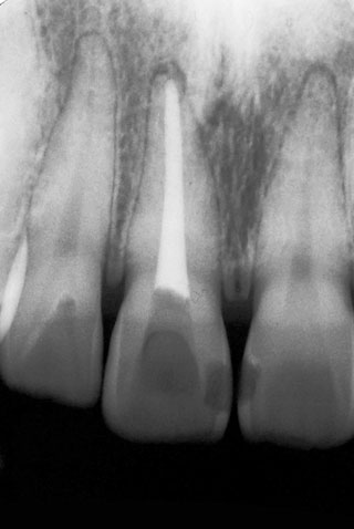 図12の患者の右側中切歯の治療経過写真