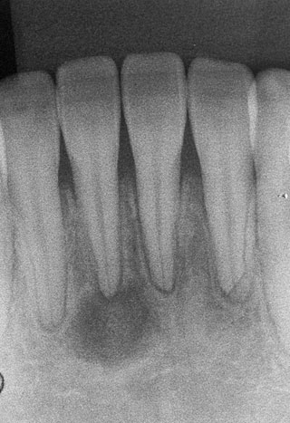 下顎右側中切歯の根尖性セメント質異形成症の1期（骨溶解期）の写真