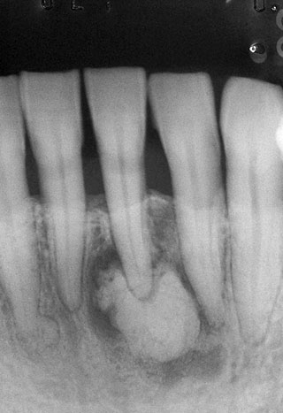 下顎左側中切歯の根尖性セメント質異形成症の2期の写真