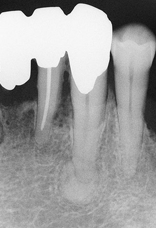 下顎左側犬歯の根尖性セメント質異形成症の3期（骨硬化期）の写真