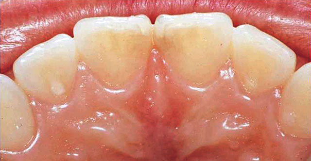 図12の患者の口蓋側面観