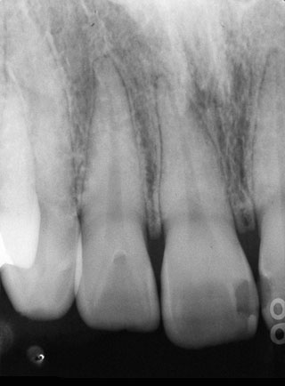 図12の患者の術前Ｘ線写真