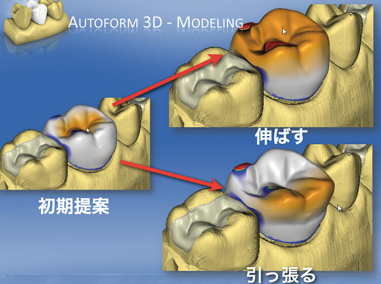 直感的操作による修復物の設計が可能となった。操作状況がリアルタイムでモニター上に反映されるため、設計状況の確認が非常にわかり易く、あらゆるバランスがとり易くなった。