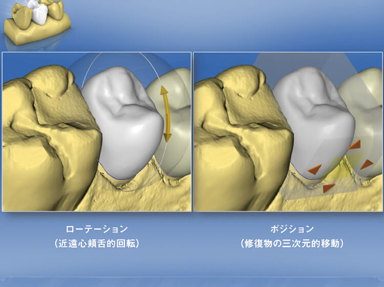 修復物のローテーション、ポジションも球面カーソルによって直感的に操作できる。操作可能な方向はV３・Xと同様である。