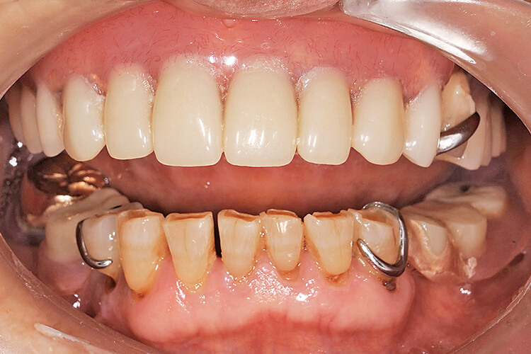 初診時の正面観（半開口時）下顎中切歯間が顔面の正中に一致している。切縁に咬耗、歯頸部に楔状欠損が認められる。