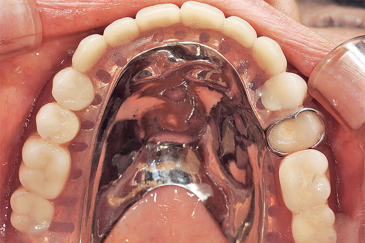 装着されていた上顎部分床義歯。