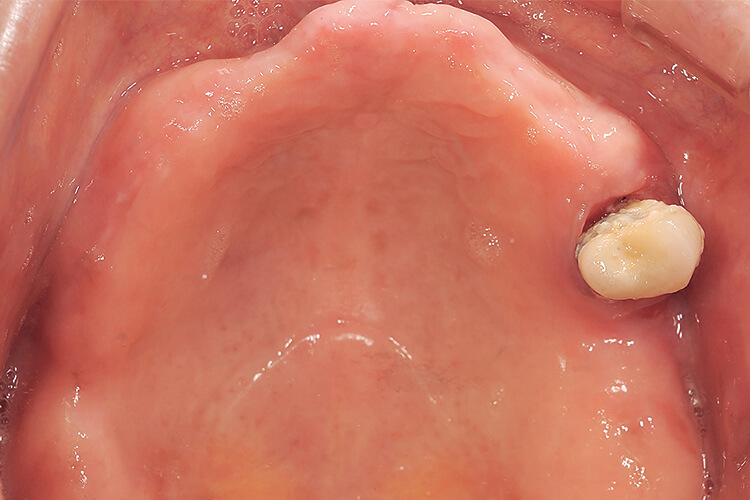 義歯を外した上顎咬合面観（義歯の沈下による粘膜の圧痕が見られる）。残存歯は動揺度３で保存不可能と判断した。