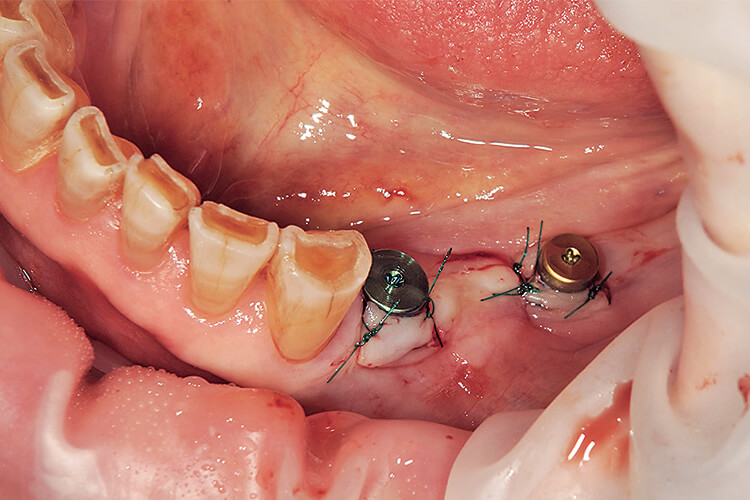下顎左側第一小臼歯部と第一大臼歯部にインプラント埋入。