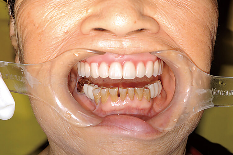 顔貌から求めた上顎中切歯の位置を基準に作製されたプロビジョナルレストレーションにより、咬合平面と咬合高径を確認する。