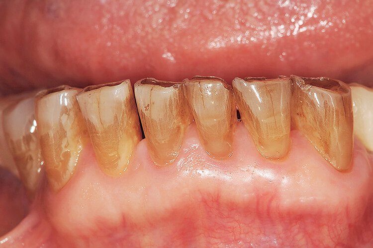 処置前の下顎前歯部（切縁の咬耗と空隙が確認できる）。