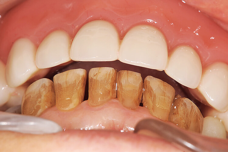 アンテリアガイダンス基準となる上顎前歯部舌側との空隙量を確認する。