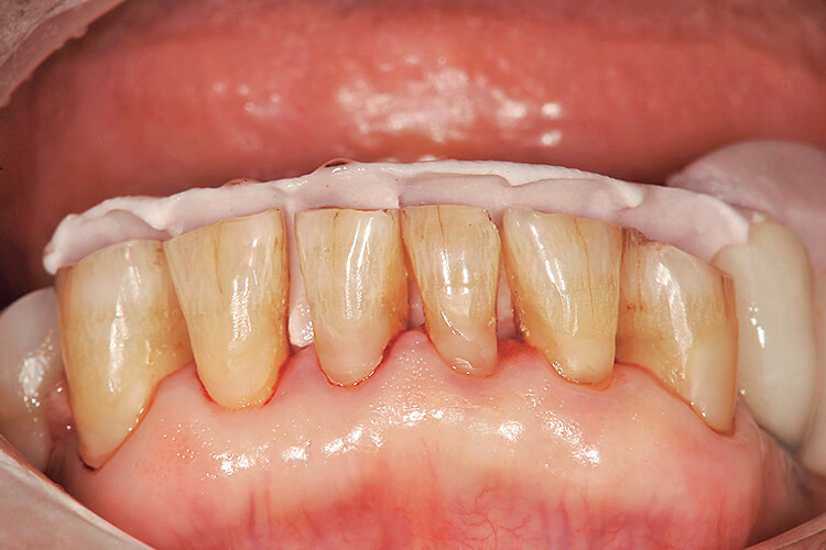歯面清掃された下顎前歯部に診断用ワックスアップから得られた形態をシリコーン・インデックスを用いて回復を行う。