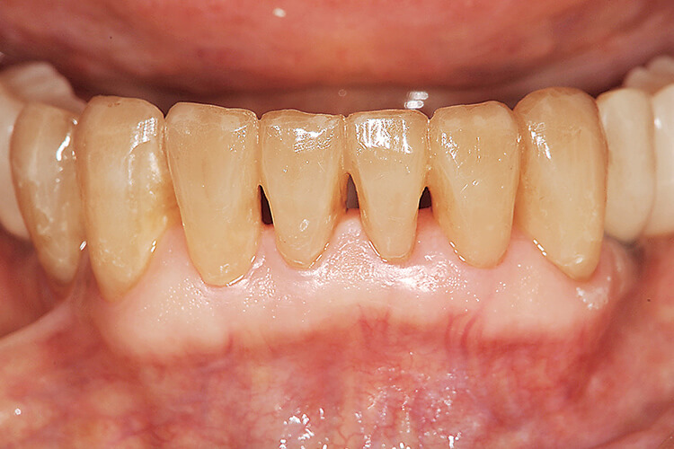 空隙や切縁形態が回復された下顎前歯部。