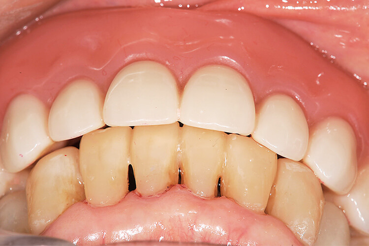 直接法コンポジットレジン充填にて修復された下顎前歯部とのカップリングの状態。