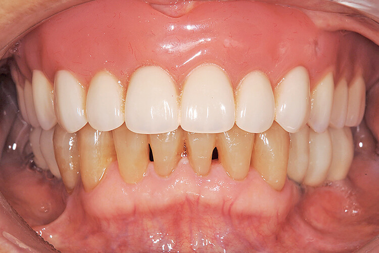 患者に使用してもらいながら、発音・咀嚼（機能面）・歯列と顔貌との調和（審美面）を再評価を行い、最終修復物の製作に移行する。