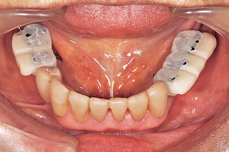 咬合器上でアバットメントと共に製作されたレジン咬合堤付きのメタルコーピングを下顎に装着する。