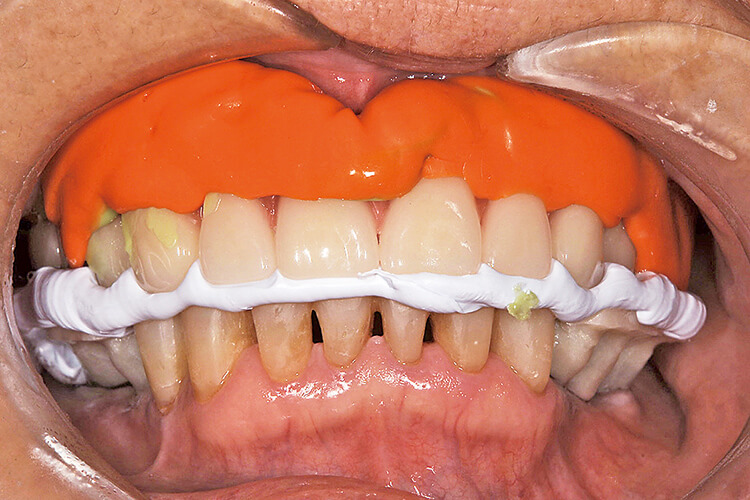 プロビジョナルデンチャーから得られた情報を元に配列された蠟義歯を用いて咬座印象と咬合採得を行う。