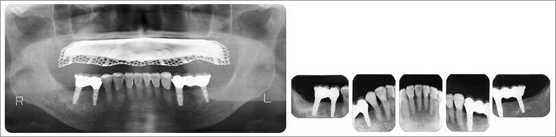 術後のパノラマ画像とデンタル画像。