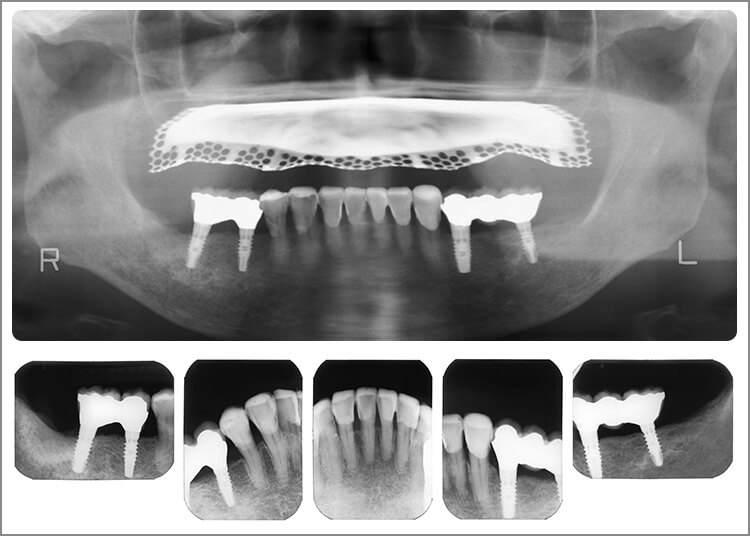 術後のパノラマ画像とデンタル画像。
