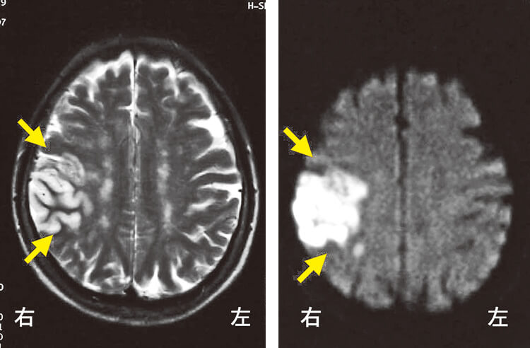 脳梗塞患者の頭部MRI画像（水平断）心房細動患者で脳梗塞（心原性脳塞栓症）を起こし、左の片麻痺、感覚障害を来した。再発予防のために、ワルファリンを服用している。このような患者に対して、抜歯時にワルファリンを中断するとさらに大きな脳梗塞を起こす危険性がある。（東京女子医科大学神経内科 飯嶋 睦先生提供）