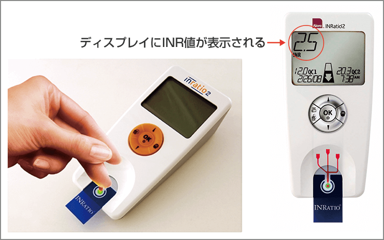 測定原理 テストストリップ中のフィブリノーゲンがフィブリンに変化するときの電気抵抗の変化からPTを測定し、INRを算出する。