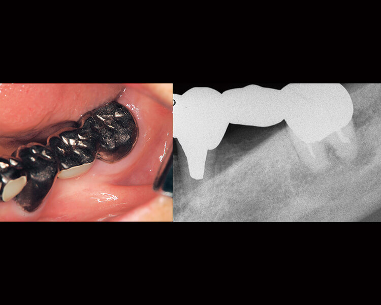 ワルファリンを継続したまま抜歯した症例 ７ 根端性歯周炎のために、ワルファリン継続下での抜歯を行った。