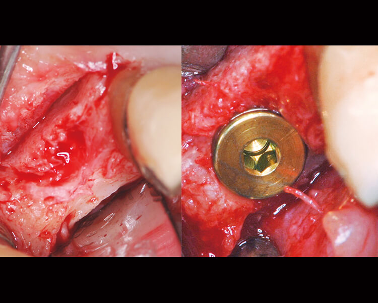 切開、粘膜骨膜弁形成。フィクスチャー埋入。ワルファリン継続したまま1本のインプラント埋入手術（直径3.8、長さ16mm）を行ったが、切開、粘膜骨膜弁の形成、ドリリング、フィクスチャー埋入時いずれも出血で術野が妨げられることはなく、縫合終了時には完全に止血し、後出血もなかった。