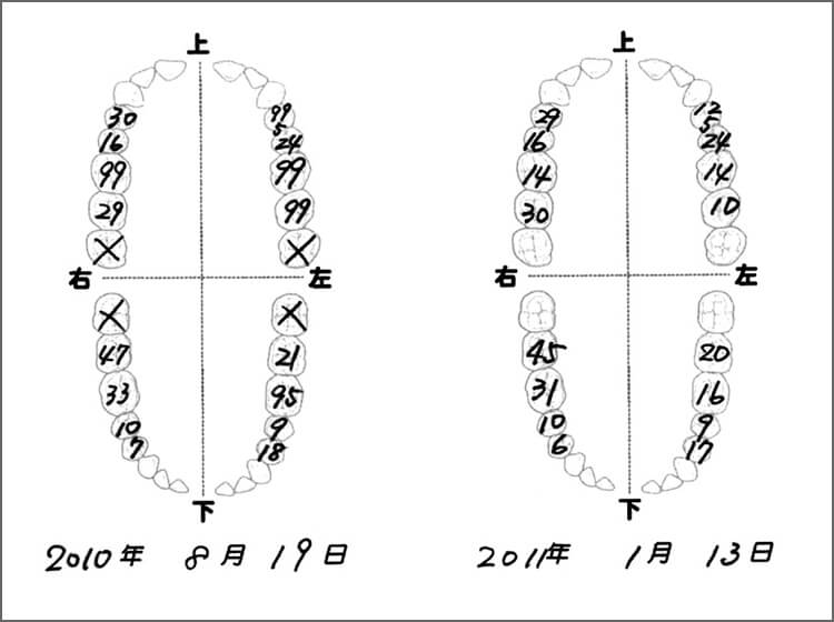 定期検診時にダイアグノデント ペン測定値を記入し、経過観察。