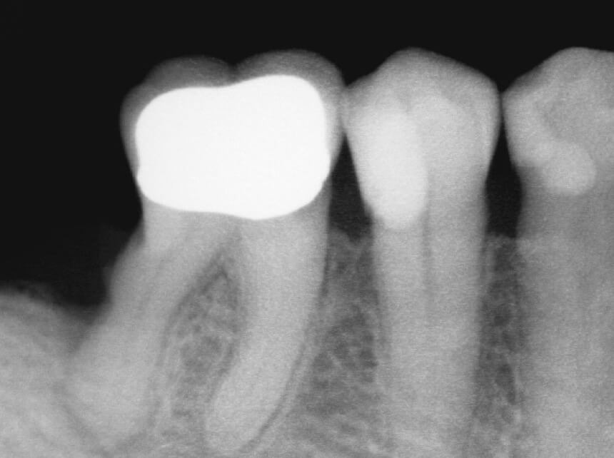 6 の遠心歯根面に歯石のような凸面がレントゲンに写っているが、ダイアグノデント ペン ペリオプローブの数値は低いので、エナメルパールまたはセメント質の過剰添加物ではないかと推測した。