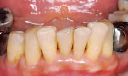 シュウ酸系知覚過敏抑制材をスケーラー等で除去し、清掃した歯面の写真