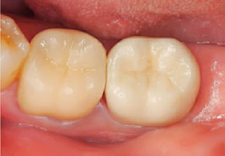 有髄歯へジルコニアセラミッククラウン使用時の写真