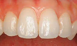 上顎前歯ホワイトニング処置前の写真