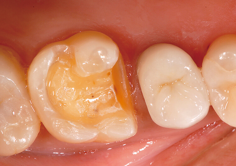 既存の充填物を除去し、ポーセレンインレーの形成を行った。