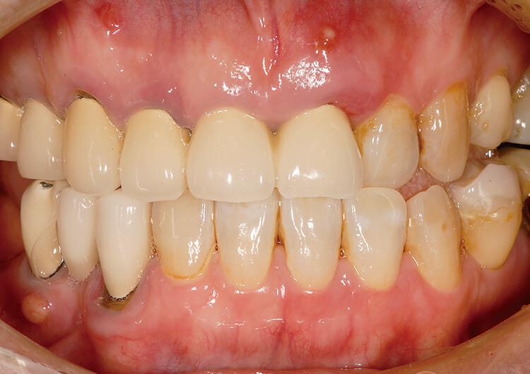 初診時。粘液性唾液、歯頸部に落としきれないプラークが層をなしている。右下3、5番抜歯。