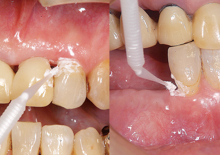 クリーニング時にインスツルメントをあてるのが困難なため、歯ブラシ、歯間ブラシ、エアースケーラーブラシでクリーニング後、ディセンシタイザーを塗布。症状が改善し「楽になった」と喜んでおられる。