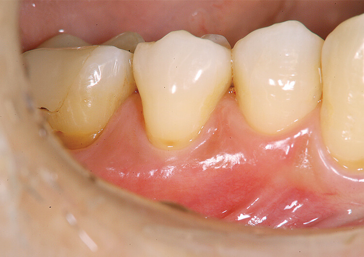 術前。プロービング値全顎3mm以下。咬合力が強くメンテナンス中に知覚過敏が発現。