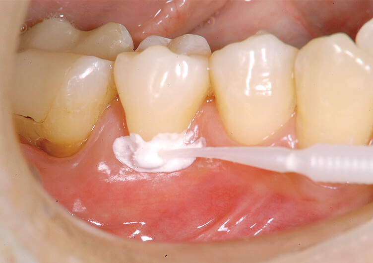術中。歯肉についても刺激がなく、サルカス内でも積極的に塗り込んでいける。