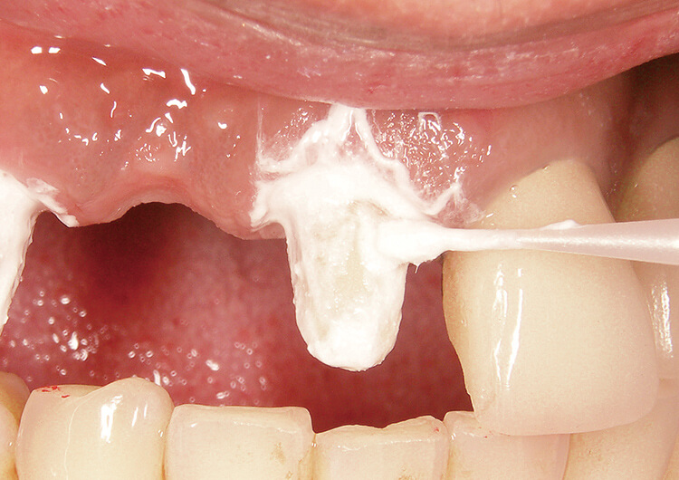 こすり塗り、水洗後、プロビジョナルクラウンを装着。