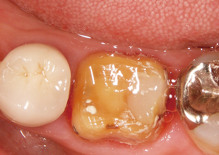 プロビジョナルクラウン除去後、知覚過敏症状があるためセメント除去や支台歯の乾燥ができない。