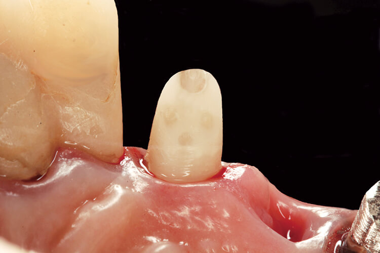 歯面処理後、スーパーボンドを用いて接着した。隣接歯の根管孔も漏斗状を呈しているため同様の術式によりクレンチングに耐えうるよう補強予定である（ミラー図）。