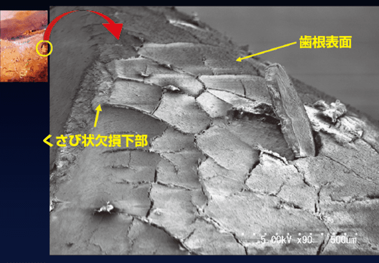 電子顕微鏡像（×90）剥離面。中年期の歯に5kgの100万回繰り返し荷重を加えたのちに、セメント質マイクロクラックが生じて、セメントの剥離も生じている所見が認められる。