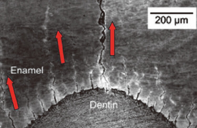 図4の歯牙に力を加え続けると、小さなTuftsが赤矢印のように歯冠外方に伸びて行く。つまりクラックは外から内方へ向かって発生するのではない。Tuftsは一種のショックアブゾーバーとして働き、これが存在しないと咬合力でエナメル質は大きく割れ落ちてしまうのではないかという仮説がある。